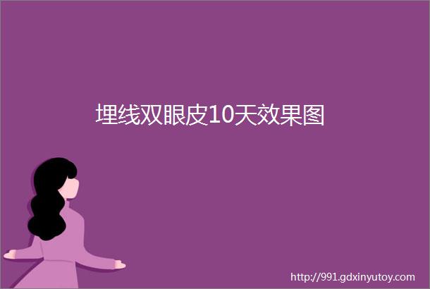 埋线双眼皮10天效果图